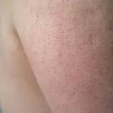 Närbild på hud med små röda prickar, typiskt för keratosis pilaris på armen.