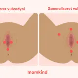 Illustration visar vulvodyni, lokaliserad och generaliserad, med röda prickar som markerar smärtpunkter. En känsla av sveda i underlivet kan uppstå.