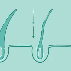 Illustration visar hur DHT påverkar hårsäckar, från friska till tunnare hårstrån. En dht blockerare kan hjälpa till att motverka detta.