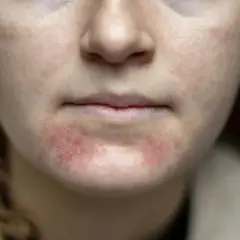 Närbild på en persons mun och haka med röda, irriterade utslag som tyder på eksem i ansiktet.