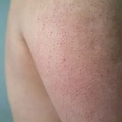 Närbild på arm med keratosis pilaris. Små röda prickar syns tydligt, vilket indikerar behov av keratosis pilaris behandling.