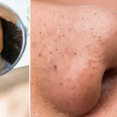 En kvinna tittar bekymrat i spegeln på sin näsa med pormaskar. Ett verktyg för att ta bort pormaskar kan vara lösningen.