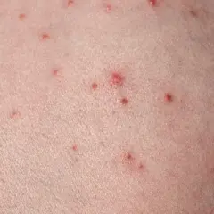 Närbild på hud med många små röda prickar, som kan likna finnar på halsen.