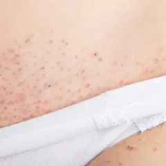 Irriterad hud efter rakning på benen, med små röda prickar och rodnad.
