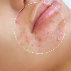 När perioral dermatit blossar upp kan stress vara en bidragande orsak. Bilden visar rodnad och små utslag runt munnen.