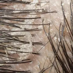 Närbild på hårbotten med fjällande hud, som kan vara tecken på svamp eller psoriasis.