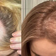 Före- och efterbilder visar tydligt hur håravfall, möjligen kopplat till stress, har minskat. Håret ser tätare ut på efterbilden.