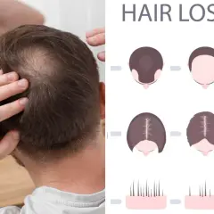 Man undersöker sitt tunnare hår. Illustrationer visar olika stadier av håravfall, vilket kan vara relaterat till alopecia areata behandling.