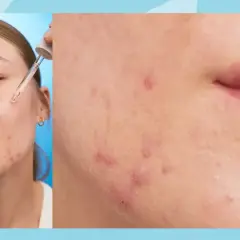 Närbild på hud med keratosis pilaris i ansiktet, där en pipett applicerar serum.