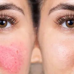 Före- och efterbild som visar effekten av hudvård för rosacea. Vänster sida visar rodnad och synliga blodkärl, höger sida visar en lugnare hud.