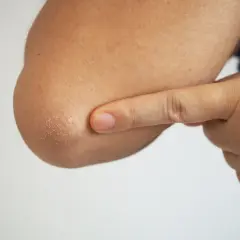 En person pekar på sina torra armbågar med fjällande hud.