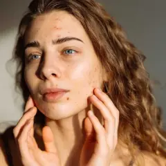 En ung kvinna med blå ögon och lockigt hår, som rör vid sitt ansikte där hon har acne i pannan och på kinderna.