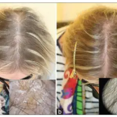 Före och efter bilder visar förbättrad hårväxt. Bild a visar tunt hår, bild b visar tätare hår. Biotin kan hjälpa mot håravfall.
