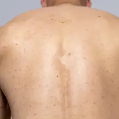Rygg med fläckar och utslag, möjligen pityriasis versicolor.