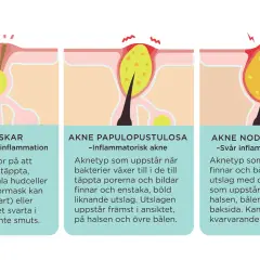Illustrationer visar olika typer av finnar orsakade av igentäppta porer och inflammation, från milda pormaskar till svår akne.