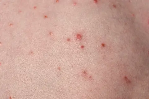 Närbild på hud med många små röda prickar, som kan likna finnar på halsen.