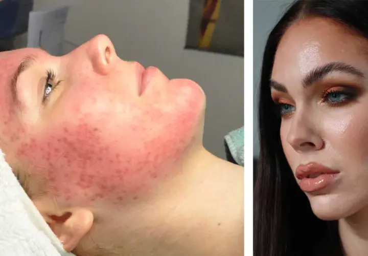 Före och efter: Ansikte med svår cystisk akne förvandlas till klar hud.