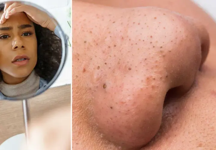 En kvinna tittar bekymrat i spegeln på sin näsa med pormaskar. Ett verktyg för att ta bort pormaskar kan vara lösningen.