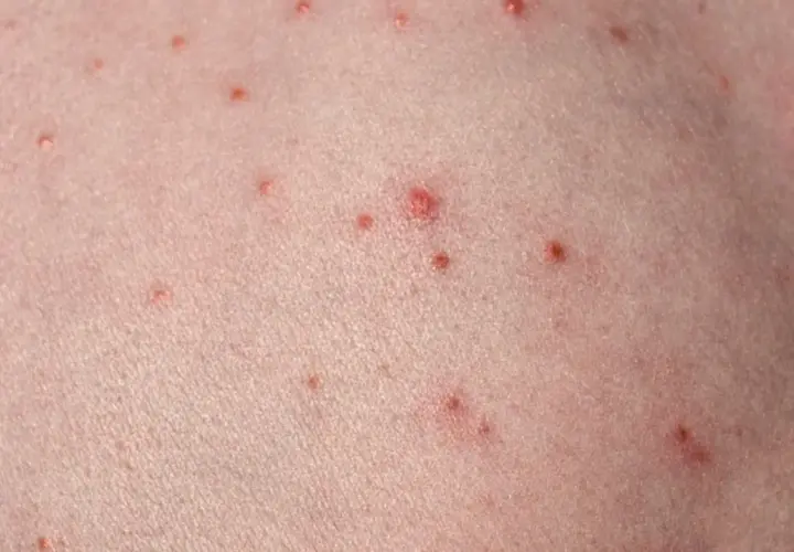 Närbild på hud med många små röda prickar, som kan likna finnar på halsen.