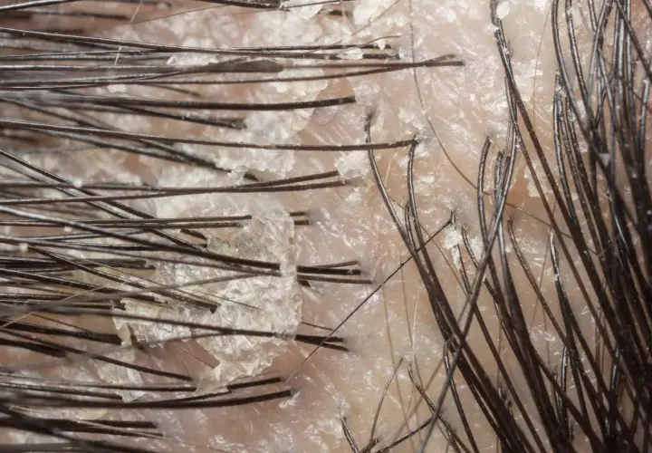 Närbild på hårbotten med fjällande hud, som kan vara tecken på svamp eller psoriasis.