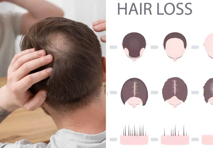 Man undersöker sitt tunnare hår. Illustrationer visar olika stadier av håravfall, vilket kan vara relaterat till alopecia areata behandling.