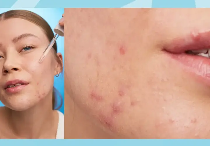 Närbild på hud med keratosis pilaris i ansiktet, där en pipett applicerar serum.
