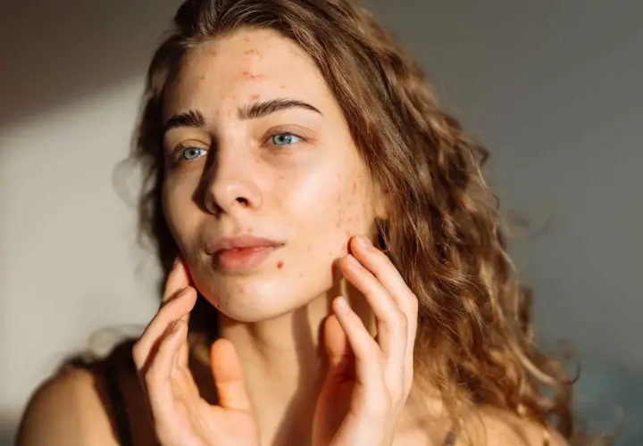 En ung kvinna med blå ögon och lockigt hår, som rör vid sitt ansikte där hon har acne i pannan och på kinderna.