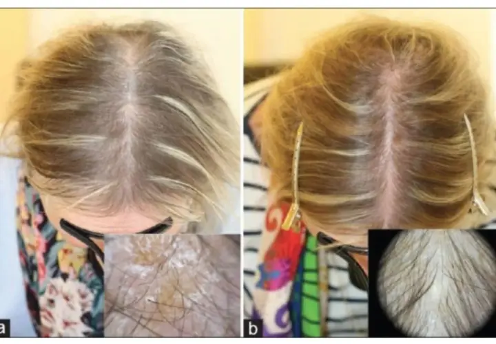 Före och efter bilder visar förbättrad hårväxt. Bild a visar tunt hår, bild b visar tätare hår. Biotin kan hjälpa mot håravfall.