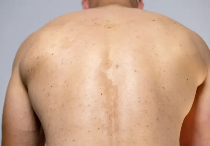 Rygg med fläckar och utslag, möjligen pityriasis versicolor.