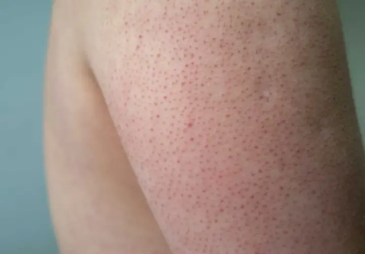 Närbild på hud med små röda prickar, typiskt för keratosis pilaris på armen.