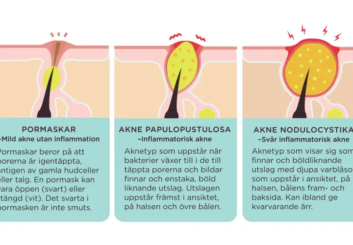 Illustrationer visar olika typer av finnar orsakade av igentäppta porer och inflammation, från milda pormaskar till svår akne.