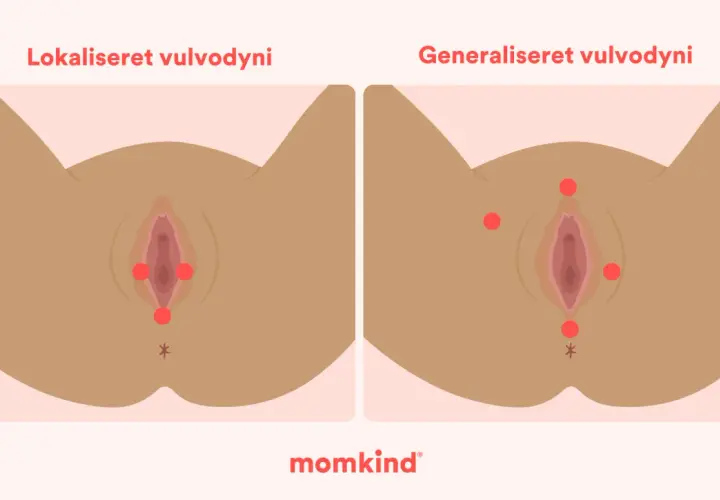 Illustration visar vulvodyni, lokaliserad och generaliserad, med röda prickar som markerar smärtpunkter. En känsla av sveda i underlivet kan uppstå.