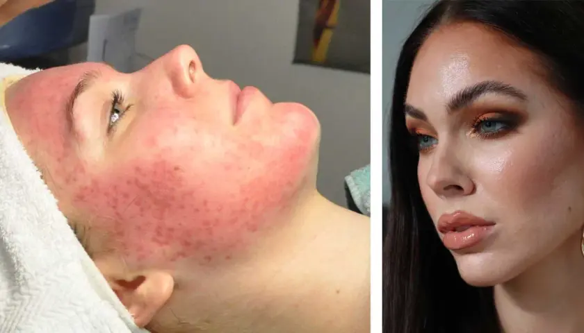 Före och efter: Ansikte med svår cystisk akne förvandlas till klar hud.