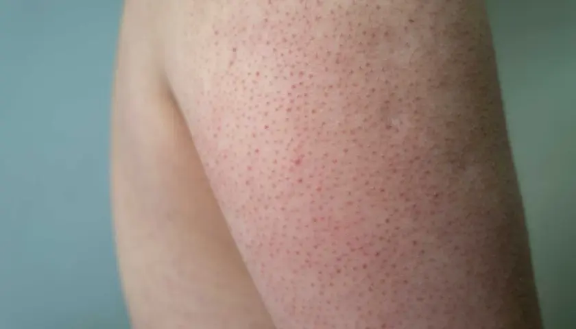 Närbild på arm med keratosis pilaris. Små röda prickar syns tydligt, vilket indikerar behov av keratosis pilaris behandling.