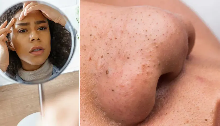 En kvinna tittar bekymrat i spegeln på sin näsa med pormaskar. Ett verktyg för att ta bort pormaskar kan vara lösningen.