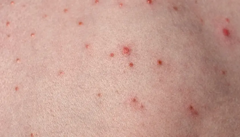 Närbild på hud med många små röda prickar, som kan likna finnar på halsen.