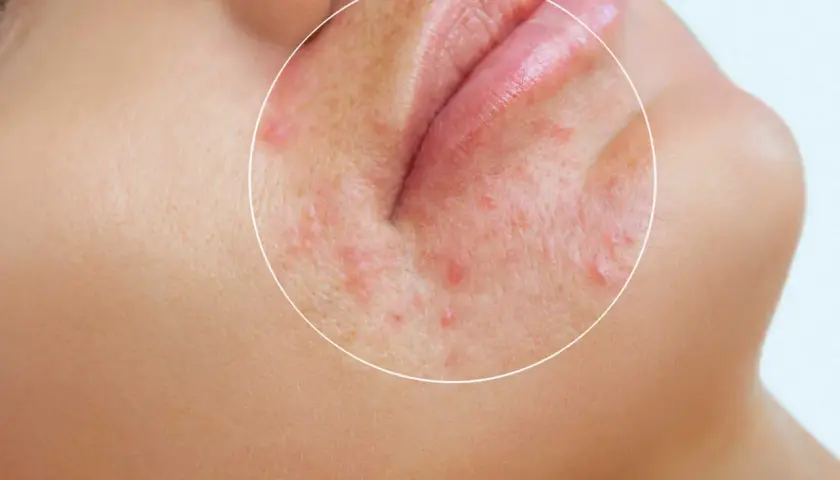 När perioral dermatit blossar upp kan stress vara en bidragande orsak. Bilden visar rodnad och små utslag runt munnen.