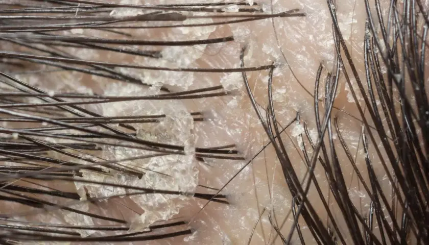 Närbild på hårbotten med fjällande hud, som kan vara tecken på svamp eller psoriasis.