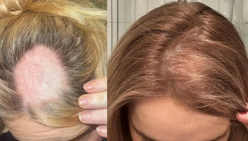Före- och efterbilder visar tydligt hur håravfall, möjligen kopplat till stress, har minskat. Håret ser tätare ut på efterbilden.