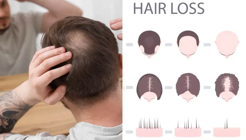 Man undersöker sitt tunnare hår. Illustrationer visar olika stadier av håravfall, vilket kan vara relaterat till alopecia areata behandling.