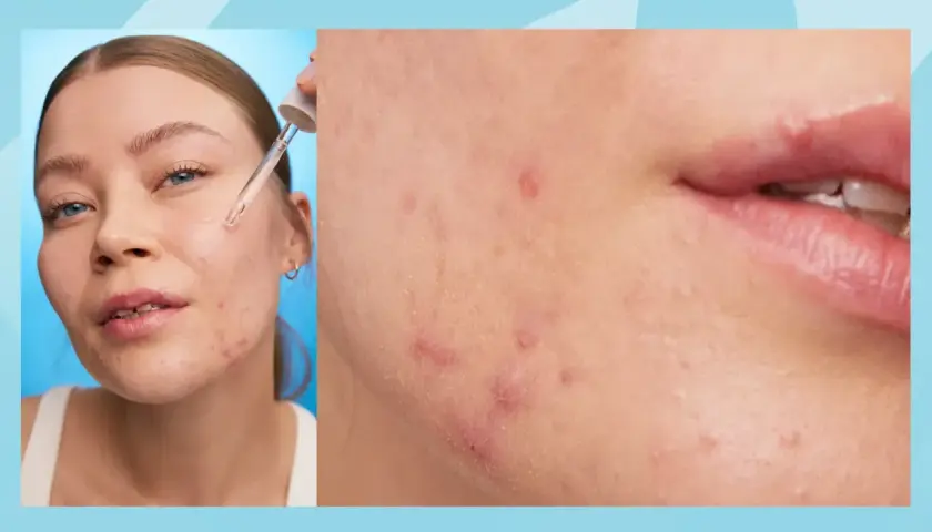 Närbild på hud med keratosis pilaris i ansiktet, där en pipett applicerar serum.