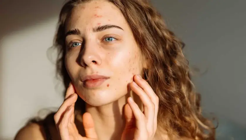 En ung kvinna med blå ögon och lockigt hår, som rör vid sitt ansikte där hon har acne i pannan och på kinderna.
