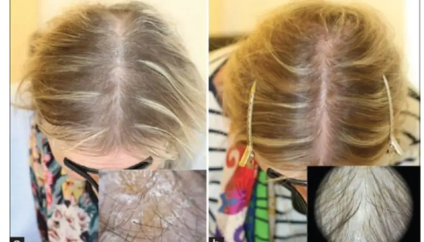 Före och efter bilder visar förbättrad hårväxt. Bild a visar tunt hår, bild b visar tätare hår. Biotin kan hjälpa mot håravfall.