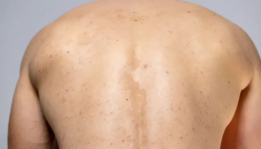 Rygg med fläckar och utslag, möjligen pityriasis versicolor.