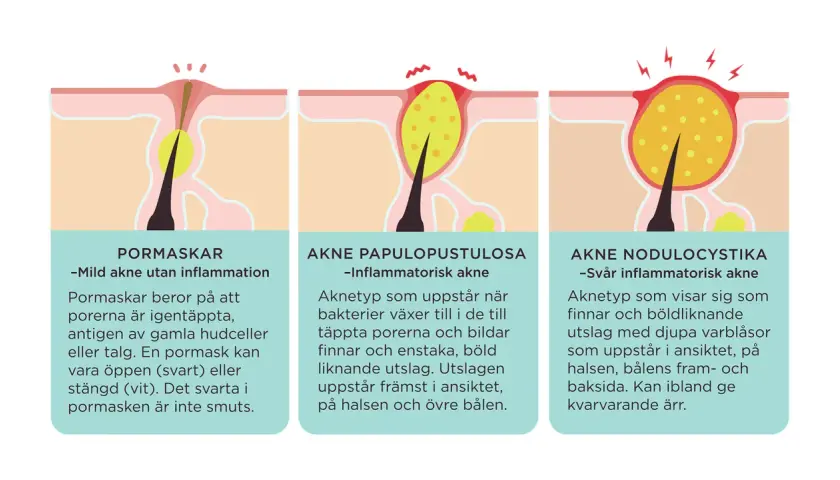 Illustrationer visar olika typer av finnar orsakade av igentäppta porer och inflammation, från milda pormaskar till svår akne.