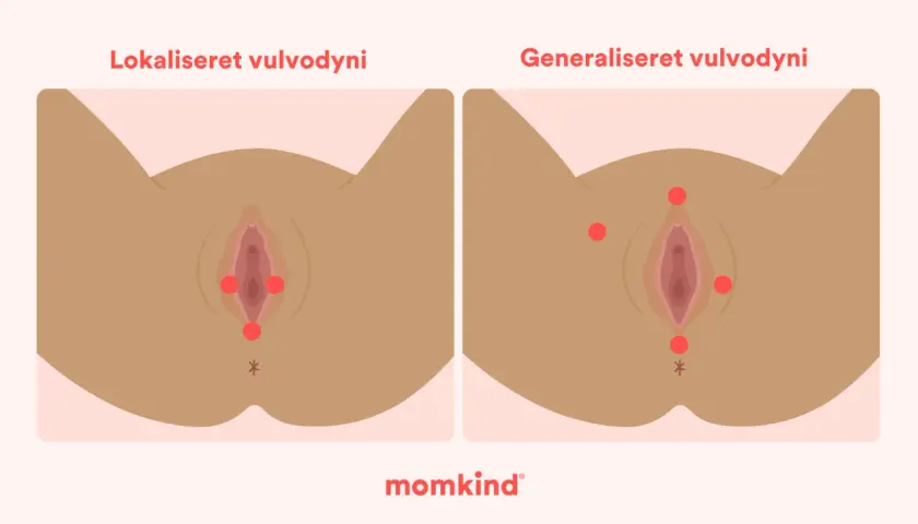 Illustration visar vulvodyni, lokaliserad och generaliserad, med röda prickar som markerar smärtpunkter. En känsla av sveda i underlivet kan uppstå.