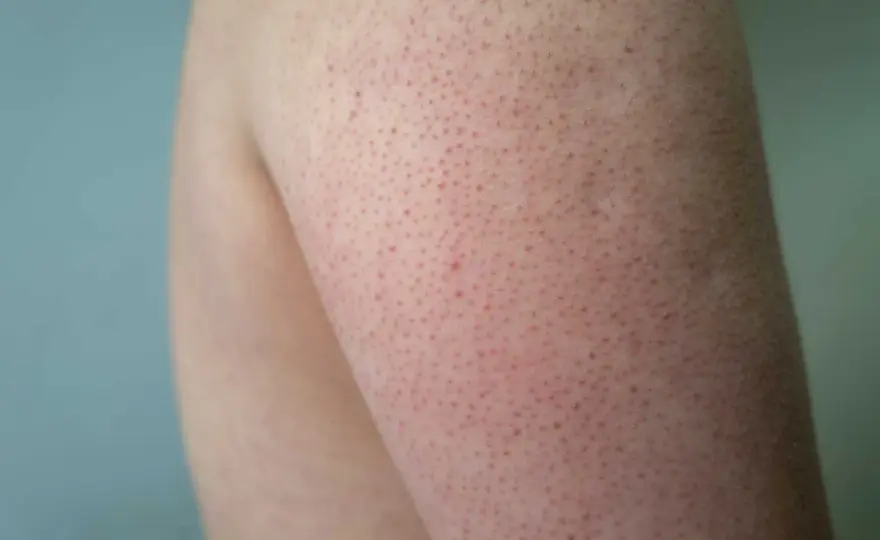 Keratosis pilaris - Så får du mjukare hud utan irritation