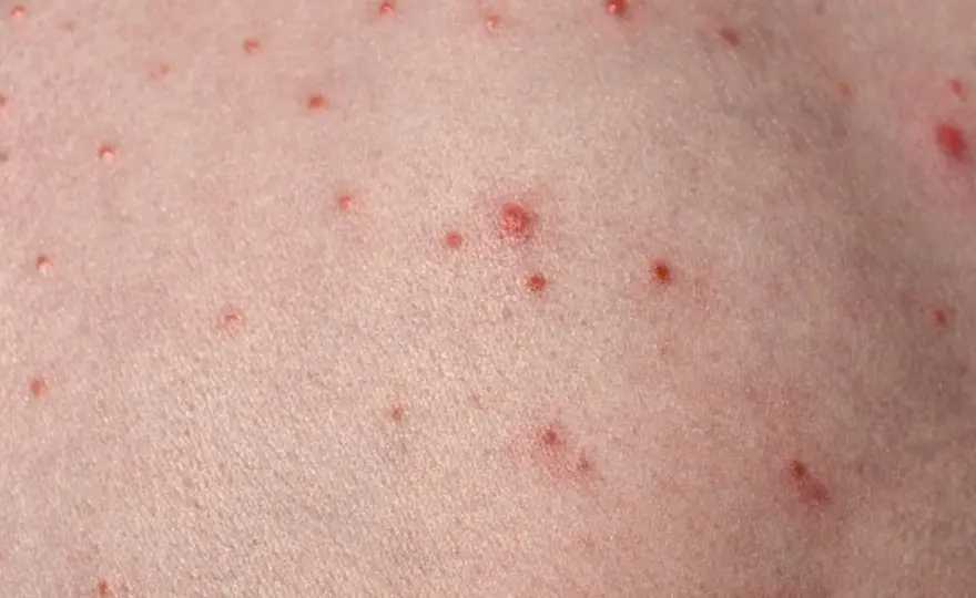 Utslag på halsen - Akne, follikulit eller irritation? Få svar här!
