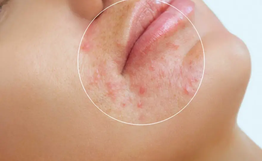 Perioral dermatit - När stress förvärrar utslagen runt munnen