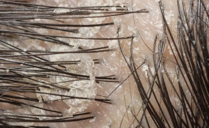 Hårbotten: Svamp, Psoriasis eller Mjälleksem? Få Rätt Svar!